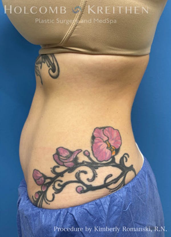 Coolsculpting Gallery - Patient 45876059 - Image 5