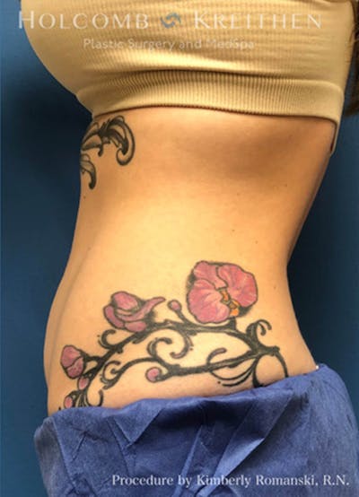 Coolsculpting Before & After Gallery - Patient 45876059 - Image 6