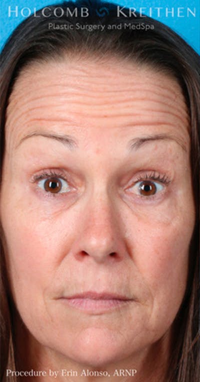 BOTOX Before & After Gallery - Patient 45876710 - Image 1