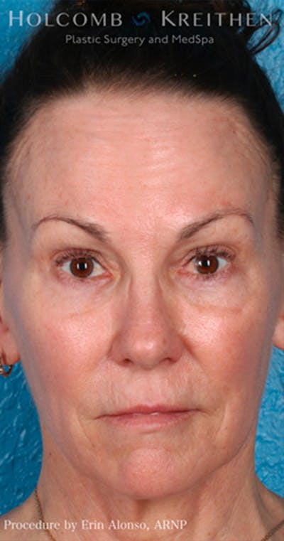 BOTOX Before & After Gallery - Patient 45876710 - Image 2