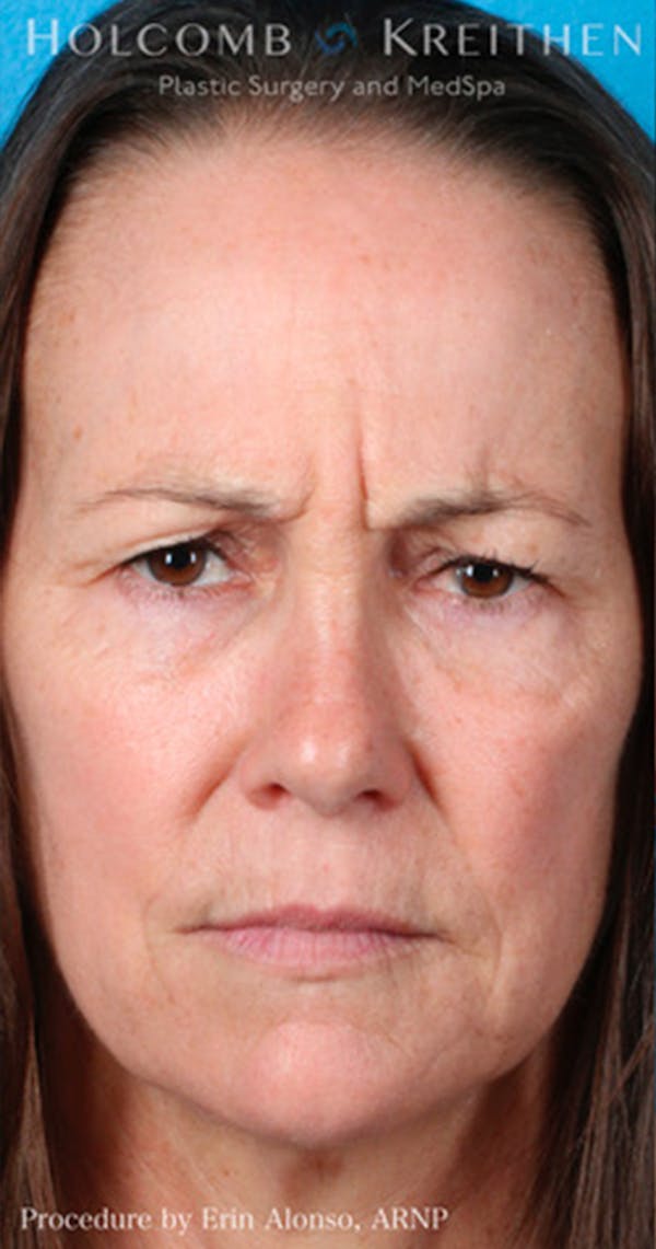 BOTOX Before & After Gallery - Patient 45876710 - Image 3