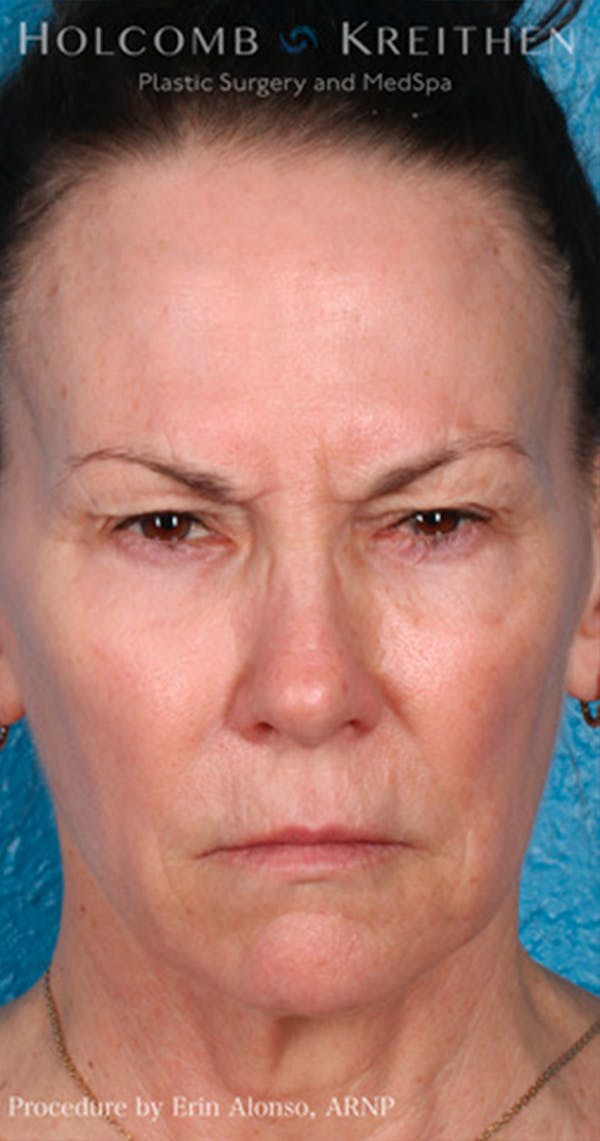 BOTOX Before & After Gallery - Patient 45876710 - Image 4