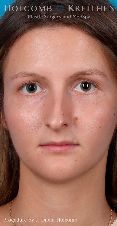 Rhinoplasty Before & After Gallery - Patient 52313850 - Image 1