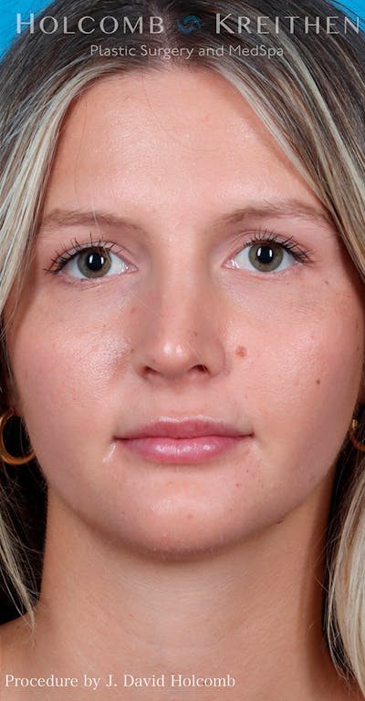 Rhinoplasty Before & After Gallery - Patient 52313850 - Image 2