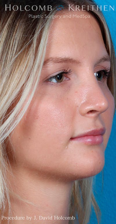 Rhinoplasty Before & After Gallery - Patient 52313850 - Image 4