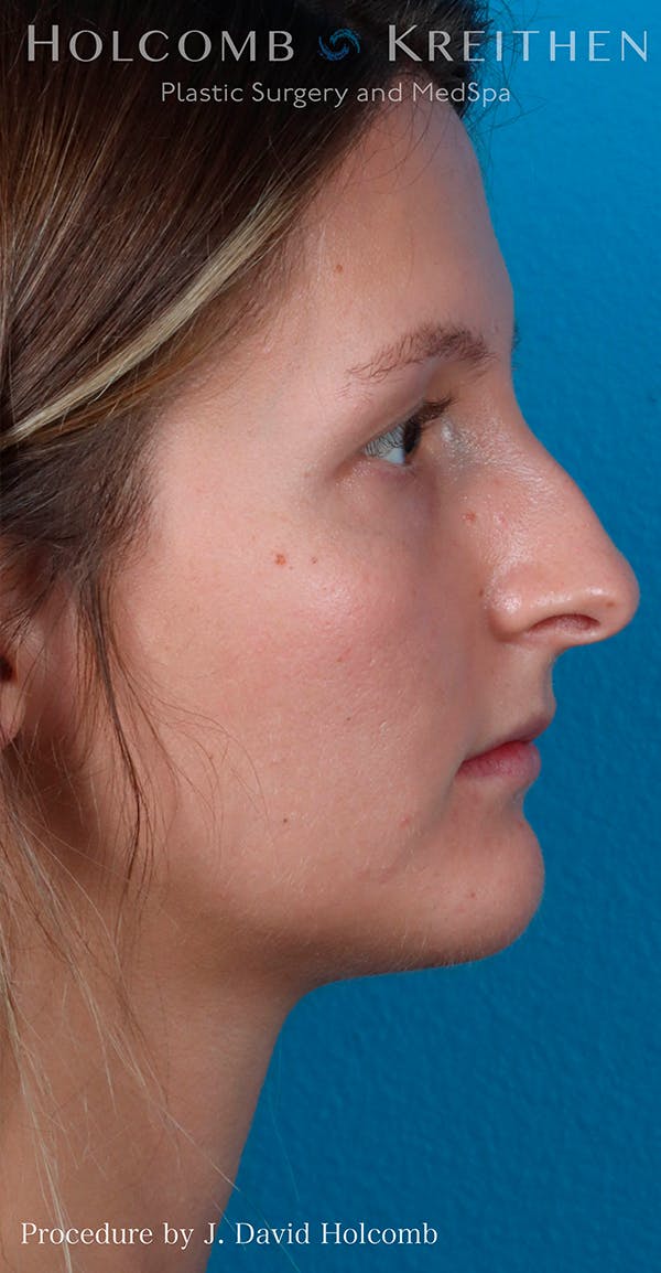 Rhinoplasty Before & After Gallery - Patient 52313850 - Image 5