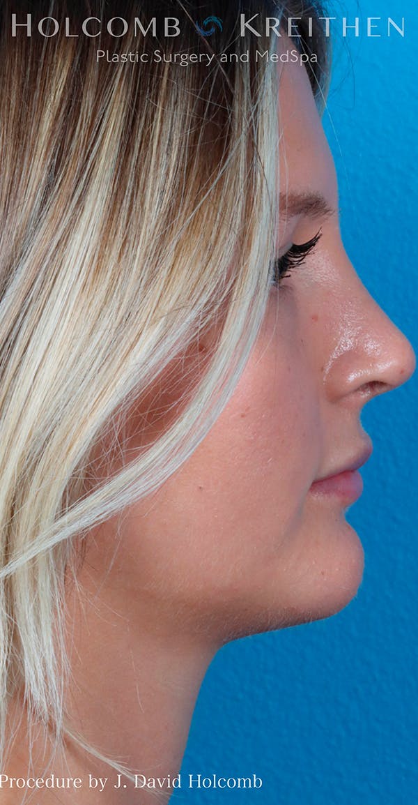 Rhinoplasty Before & After Gallery - Patient 52313850 - Image 6