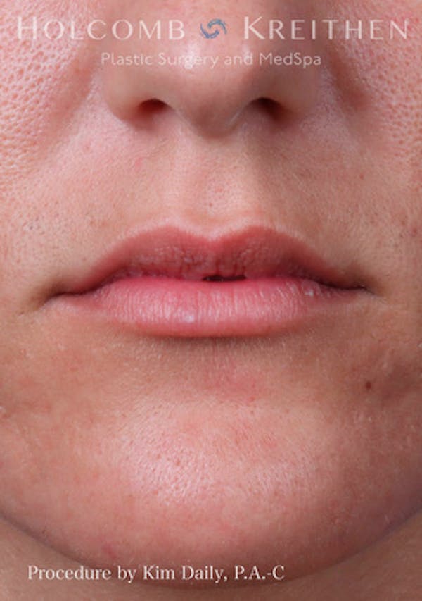 Fillers Before & After Gallery - Patient 60071532 - Image 1