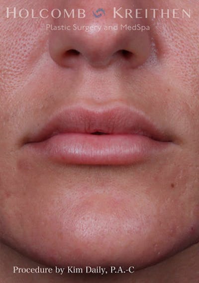 Fillers Before & After Gallery - Patient 60071532 - Image 2