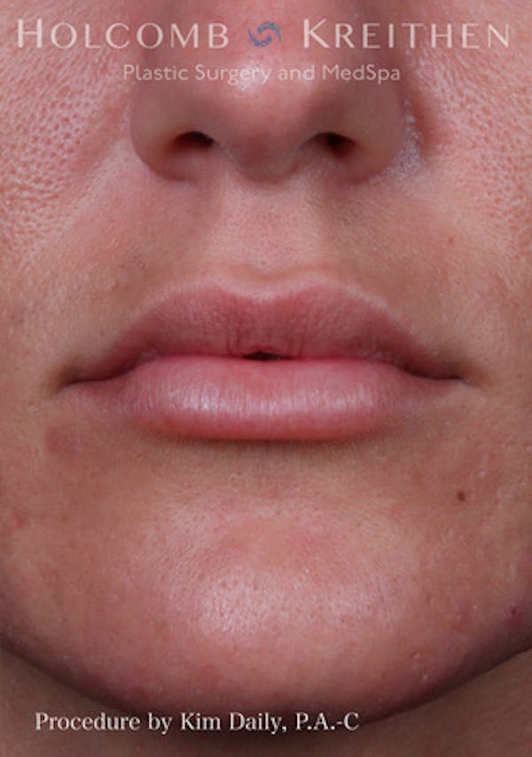 Fillers Before & After Gallery - Patient 60071532 - Image 2