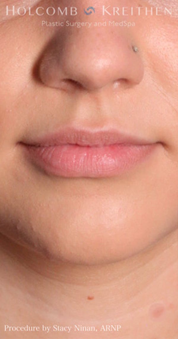 Fillers Before & After Gallery - Patient 60071533 - Image 1
