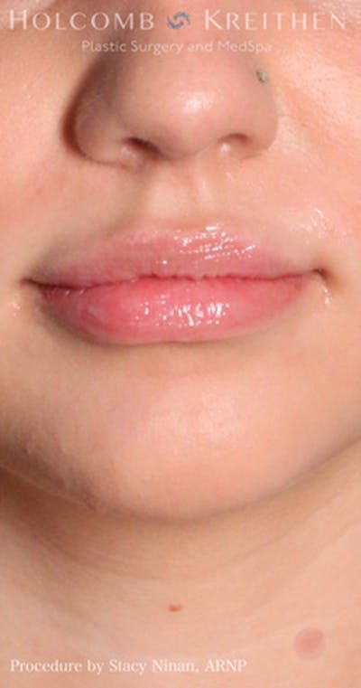 Fillers Before & After Gallery - Patient 60071533 - Image 2