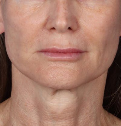 Fillers Gallery - Patient 61837737 - Image 2