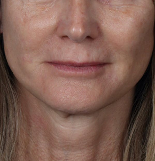 Fillers Before & After Gallery - Patient 61837737 - Image 1