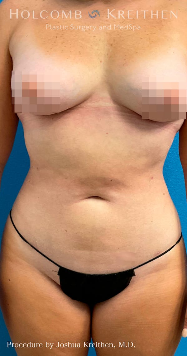 Liposuction Before & After Gallery - Patient 72745261 - Image 2