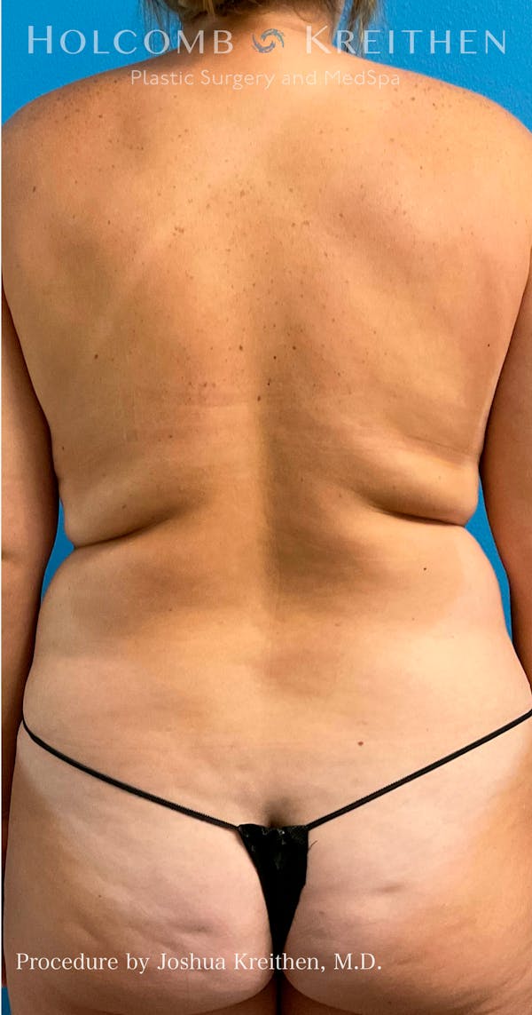 Liposuction Before & After Gallery - Patient 72745261 - Image 3