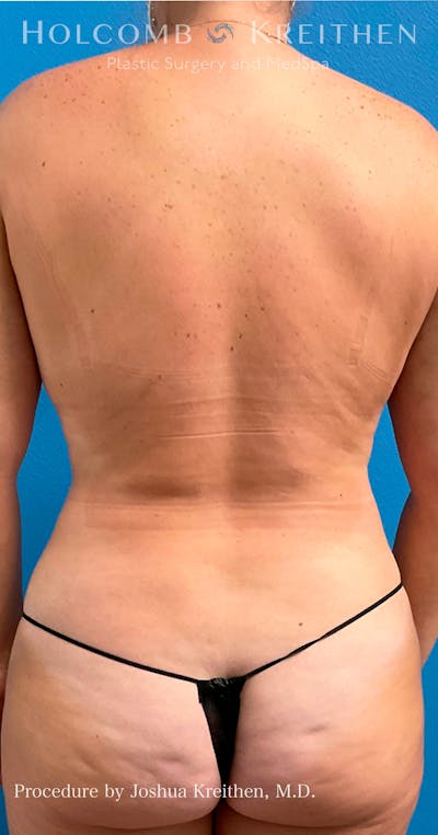 Liposuction Before & After Gallery - Patient 72745261 - Image 4