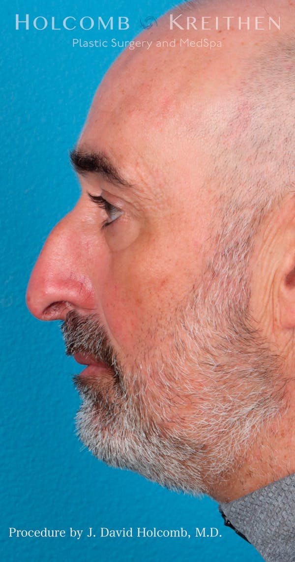 Rhinoplasty Before & After Gallery - Patient 72745740 - Image 7