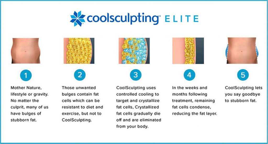 coolsculpting elite picture of the skin 