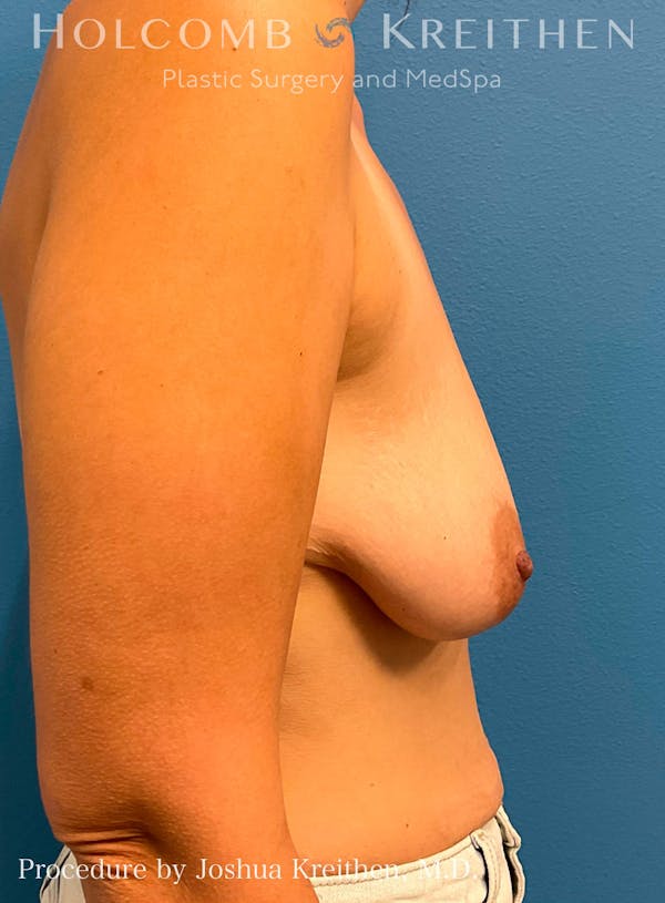 Breast Augmentation with Lift Before & After Gallery - Patient 100339077 - Image 9