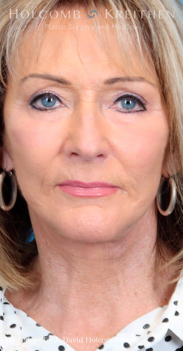 Laser/RF Assisted Facelift Gallery - Patient 100342814 - Image 2