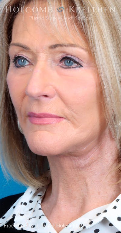Laser/RF Assisted Facelift Gallery - Patient 100342814 - Image 8