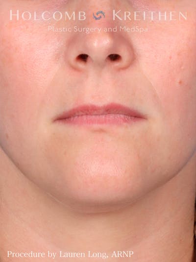 Fillers Before & After Gallery - Patient 109010190 - Image 1