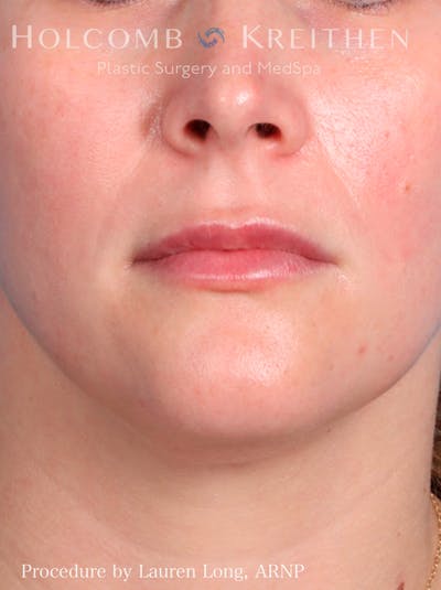 Fillers Before & After Gallery - Patient 109010190 - Image 2
