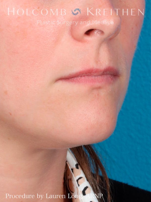 Fillers Before & After Gallery - Patient 109010190 - Image 3