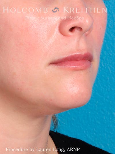 Fillers Before & After Gallery - Patient 109010190 - Image 4