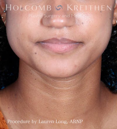 BOTOX Before & After Gallery - Patient 109010303 - Image 1