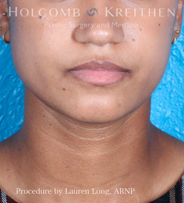 BOTOX Before & After Gallery - Patient 109010303 - Image 2