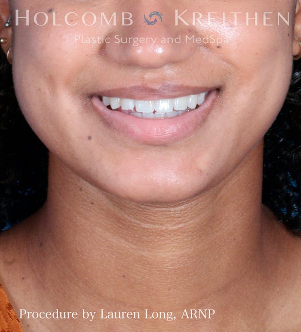 BOTOX Before & After Gallery - Patient 109010303 - Image 3