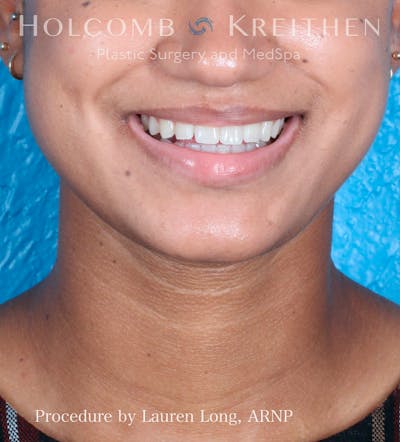 BOTOX Before & After Gallery - Patient 109010303 - Image 4