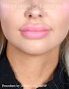 fillers