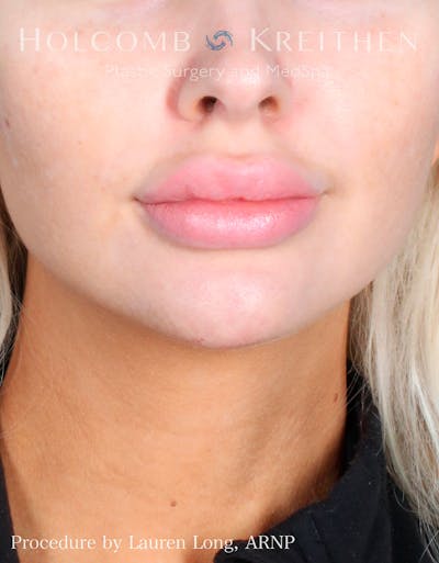 Fillers Before & After Gallery - Patient 109010309 - Image 2