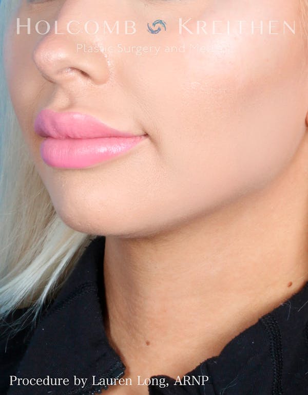 Fillers Before & After Gallery - Patient 109010309 - Image 3