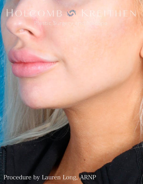 Fillers Before & After Gallery - Patient 109010309 - Image 4