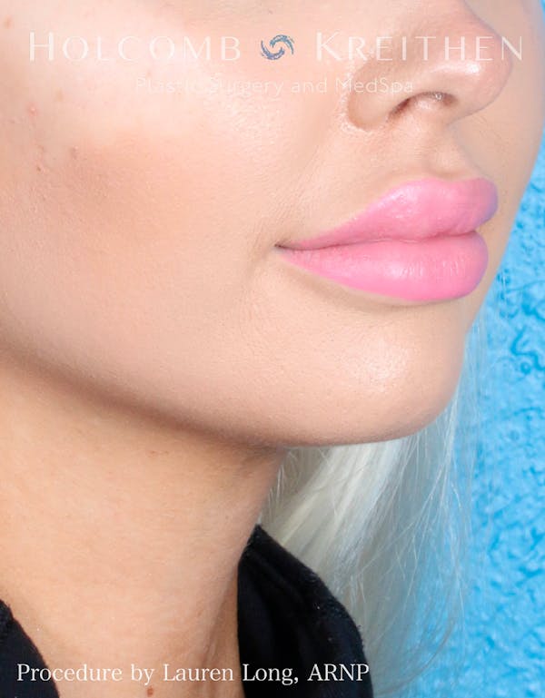 Fillers Before & After Gallery - Patient 109010309 - Image 5