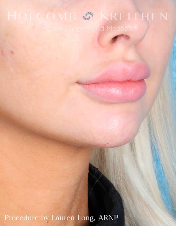 Fillers Before & After Gallery - Patient 109010309 - Image 6
