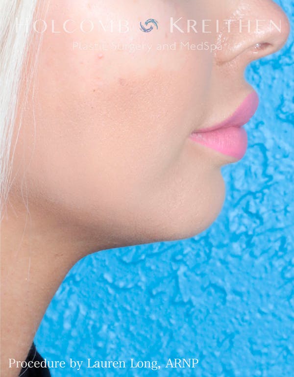 Fillers Before & After Gallery - Patient 109010309 - Image 7