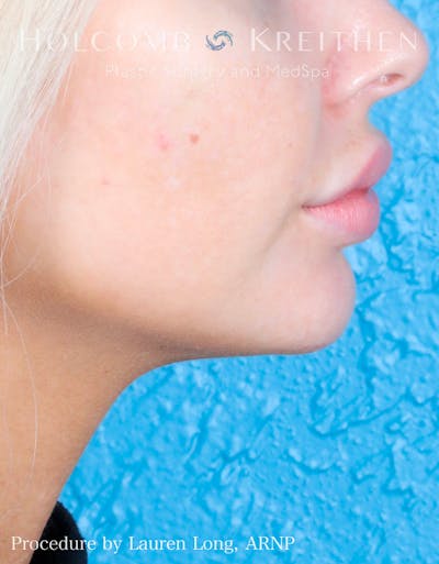 Fillers Before & After Gallery - Patient 109010309 - Image 8