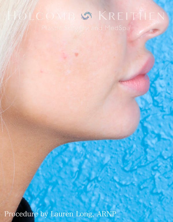 Fillers Before & After Gallery - Patient 109010309 - Image 8