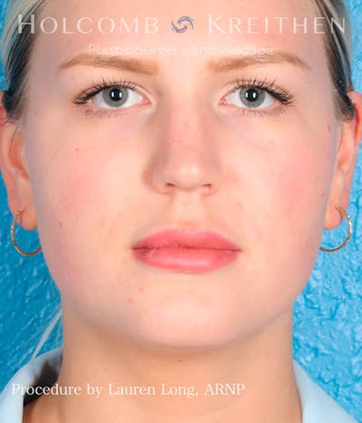 Fillers Before & After Gallery - Patient 113205551 - Image 1