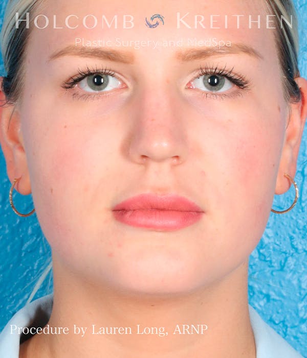 Fillers Before & After Gallery - Patient 113205551 - Image 1