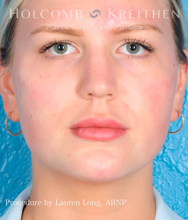 Fillers Before & After Gallery - Patient 113205551 - Image 2
