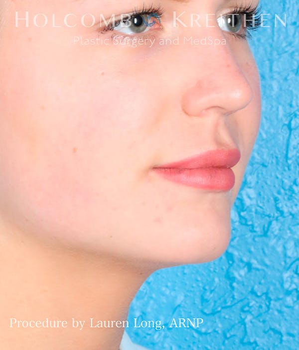 Fillers Gallery - Patient 113205551 - Image 3