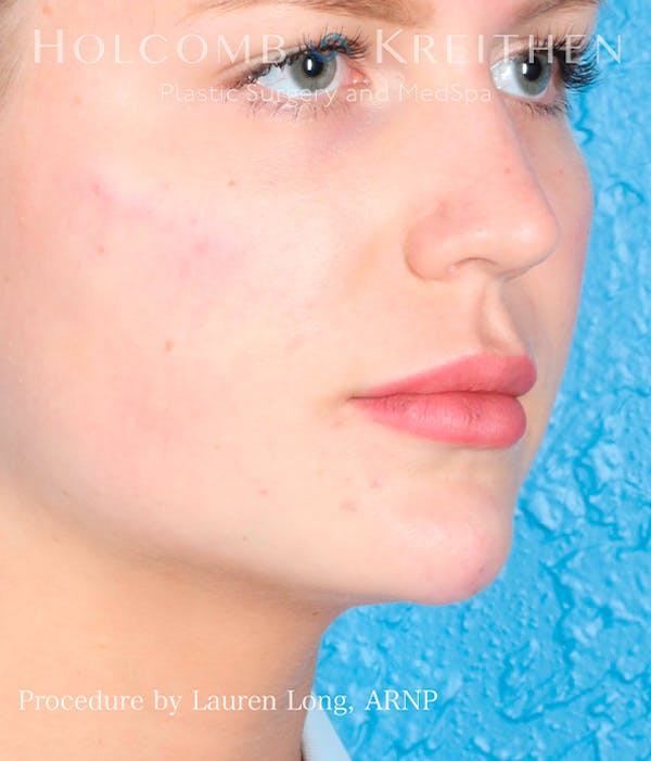 Fillers Before & After Gallery - Patient 113205551 - Image 4