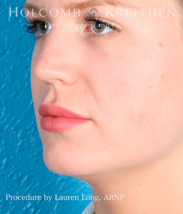 Fillers Before & After Gallery - Patient 113205551 - Image 5