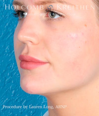 Fillers Before & After Gallery - Patient 113205551 - Image 6
